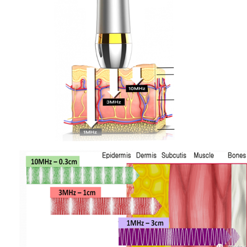 Dụng cụ làm đẹp siêu âm 10 MHz do công ty phát triển